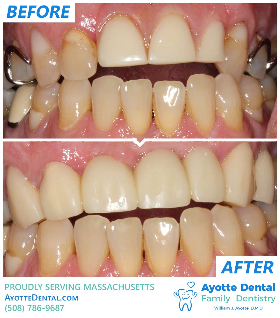 Dental bridge before and after.