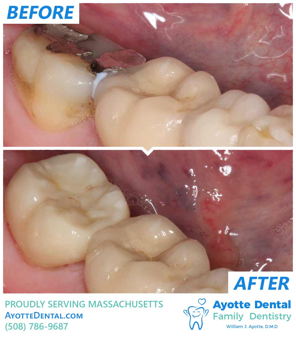 Large amalgam restoration - replaced with all ceramic crown before and after.