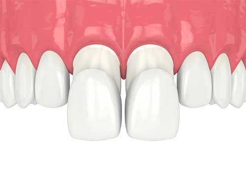 porcelain veneers on front teeth.