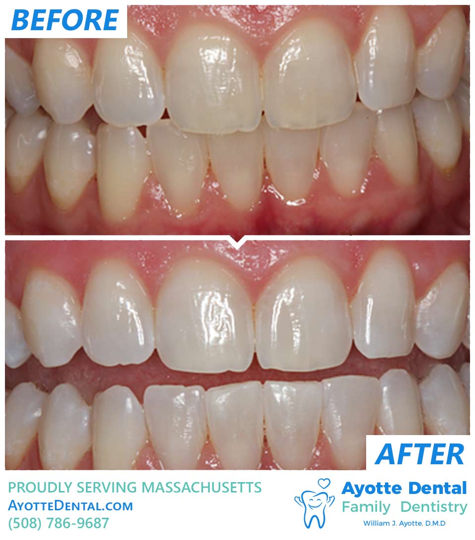 Teeth whitening before and after.