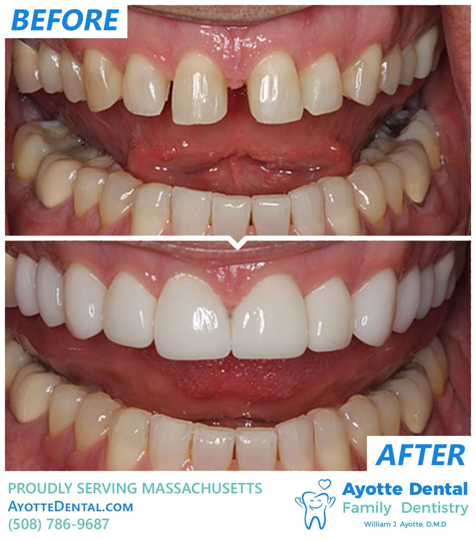 Veneers before and after.